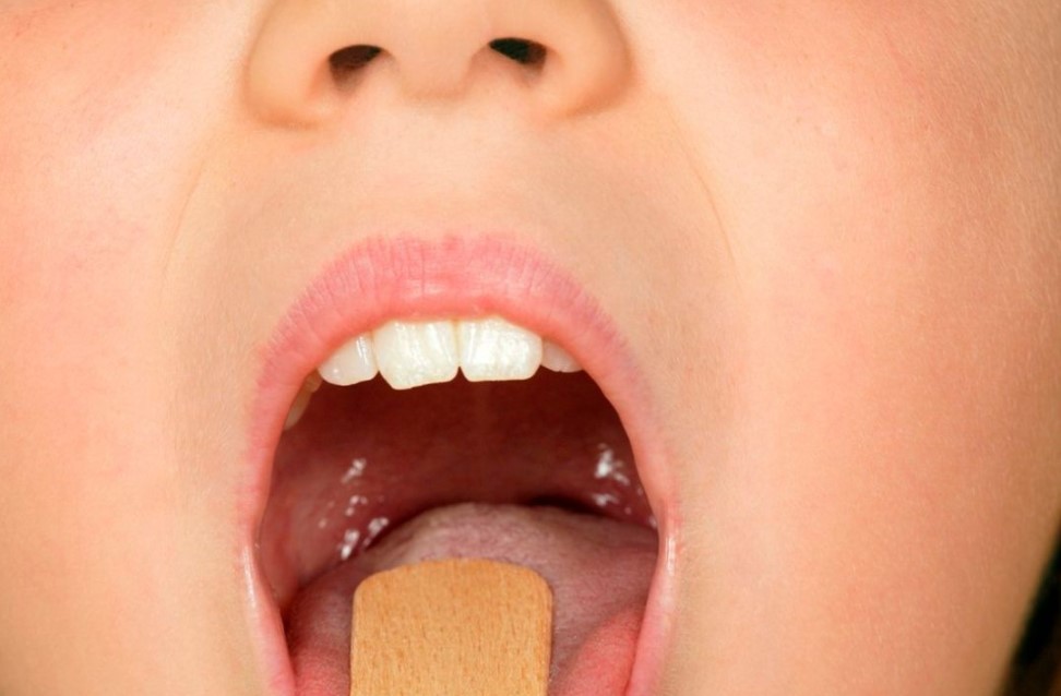 Is Mouthwash Good for Tonsil Stones