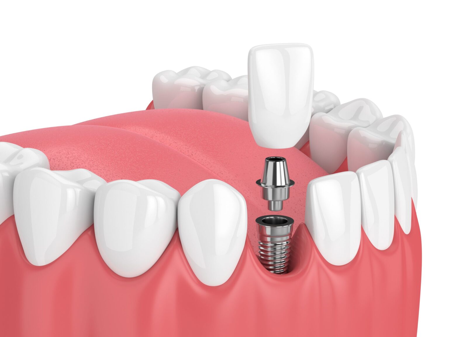Costs of Dental Implants & Financing Options