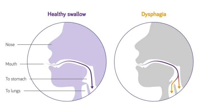 nutricia-stroke-dysphagia-swallowing-difficulties-illustration