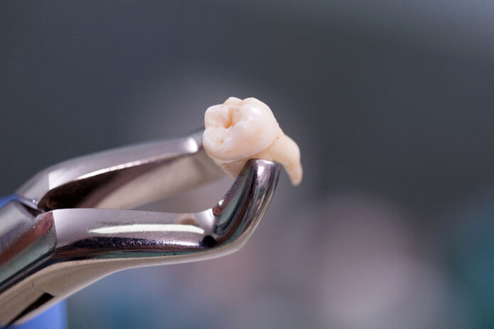 Can Wisdom Teeth Come in Normally