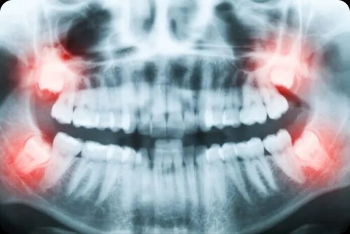 Signs That Wisdom Teeth Are Coming In