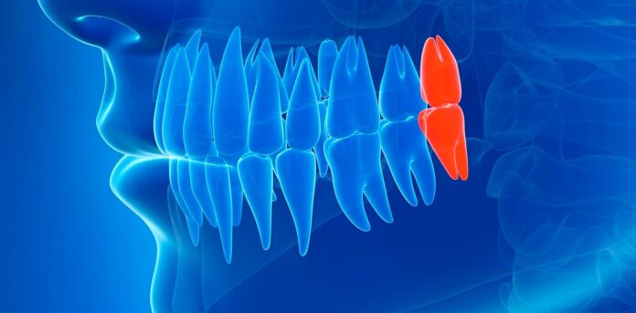 When Do Wisdom Teeth Typically Erupt