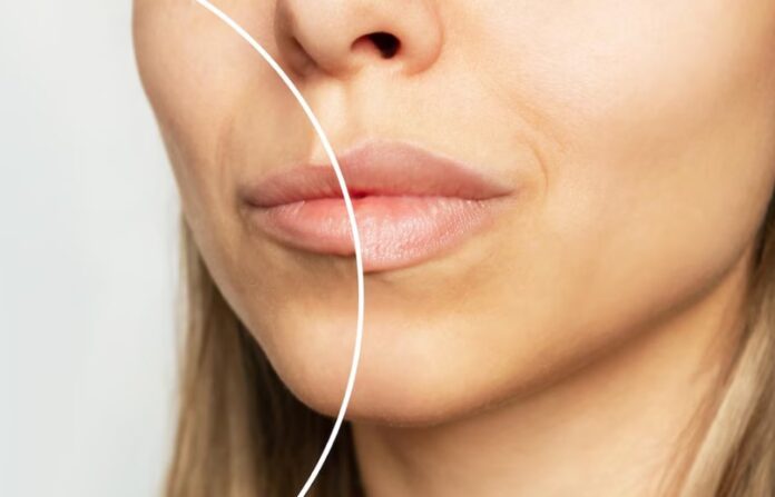 Why So Many People Are Choosing Lip Fillers